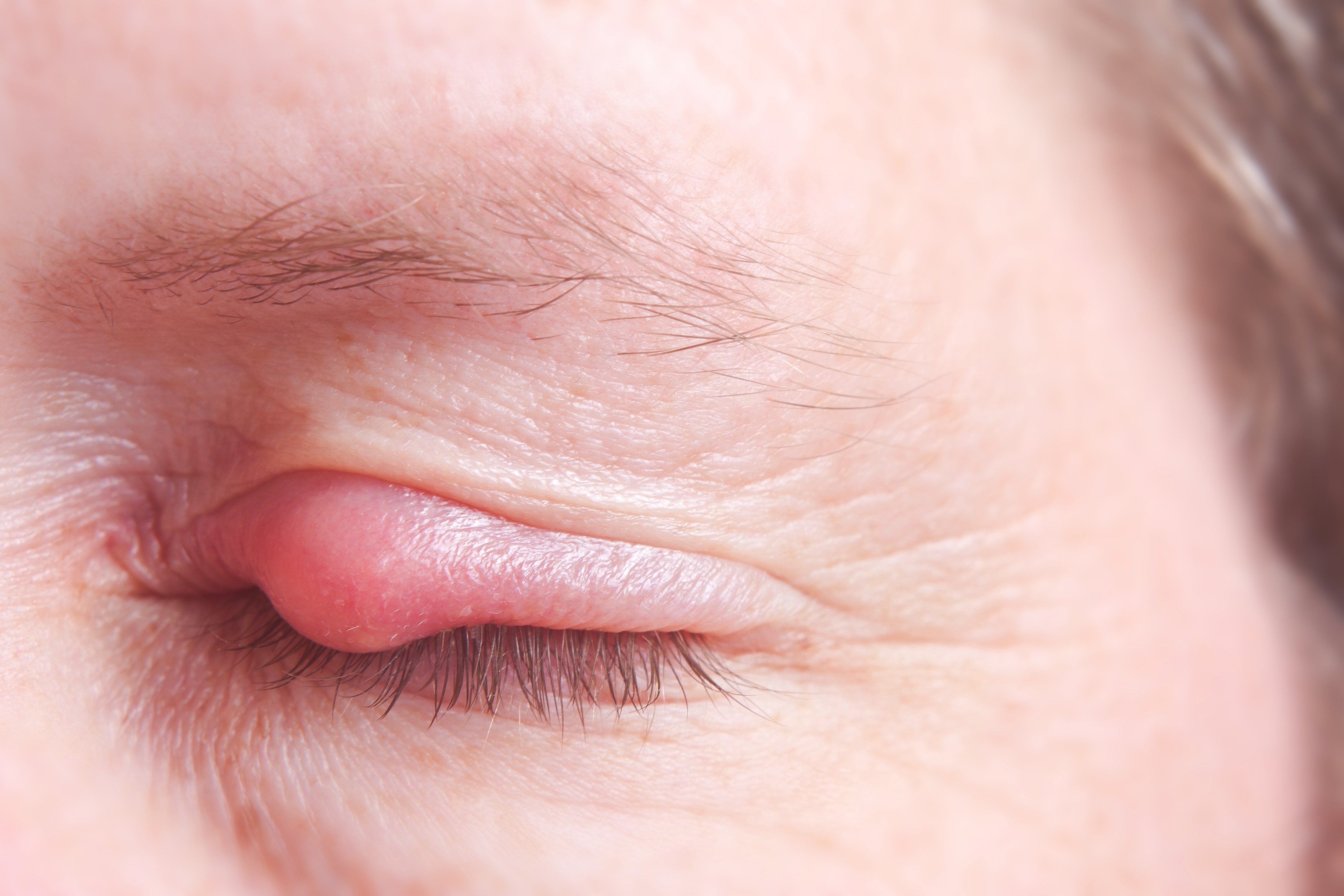 Eye problems